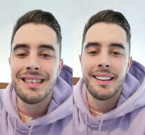 Facettes Dentaires Instant Smile – Mâchoire Supérieure et Inférieure Incluses