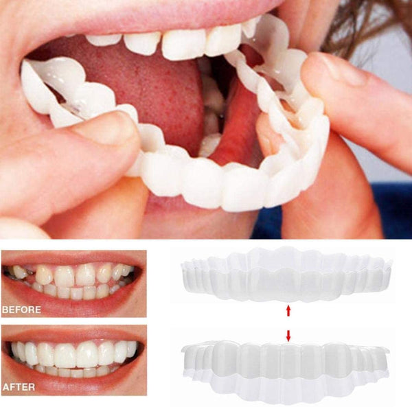 Facettes Dentaires Instant Smile – Mâchoire Supérieure et Inférieure Incluses